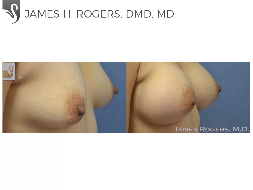 Before and After Image: Breast Augmentation Case #41307 - right-front-oblique