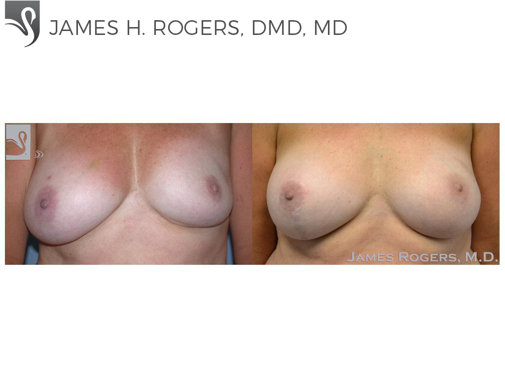 Before and After Image: Breast Reconstruction Case #41320 - front
