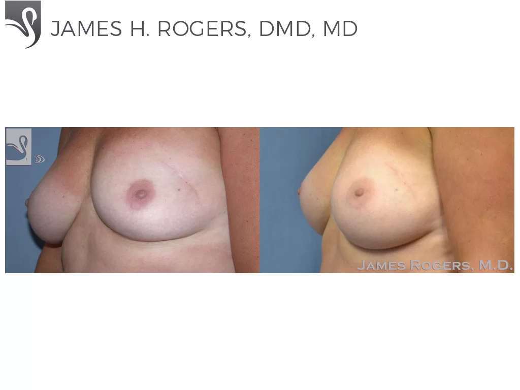 Before and After Image: Breast Reconstruction Case #41320 - left-front-oblique