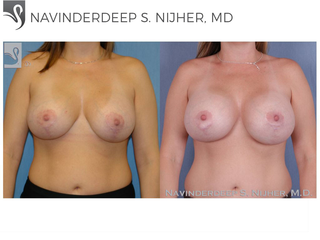Before and After Image: Breast Revisions Case #41358 - front