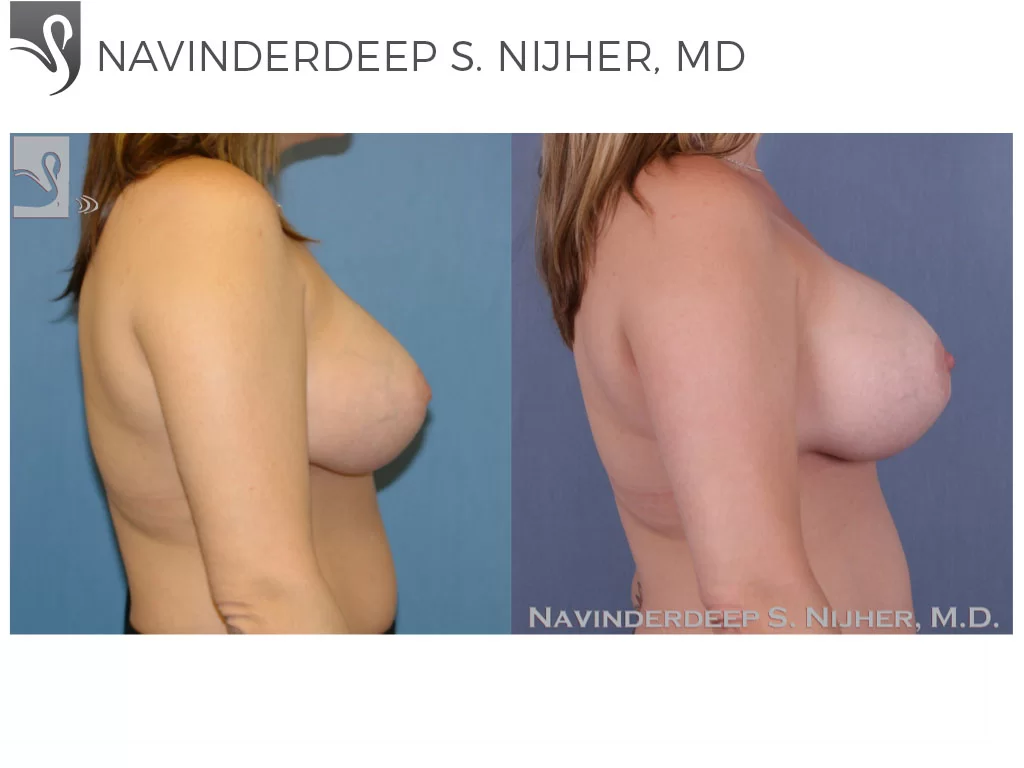 Before and After Image: Breast Revisions Case #41358 - right-side