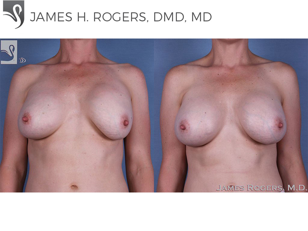 Before and After Image: Breast Revisions Case #41484 - front