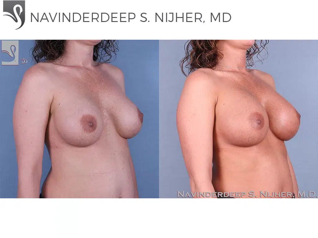 Before and After Image: Breast Revisions Case #41991 - right-front-oblique