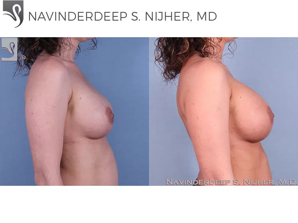 Before and After Image: Breast Revisions Case #41991 - right-side