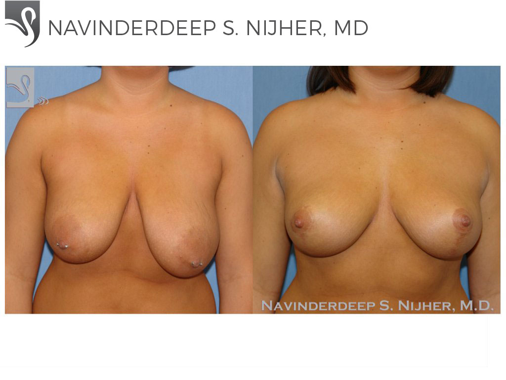 Before and After Image: Breast Lift (Mastopexy) Case #42185 - front