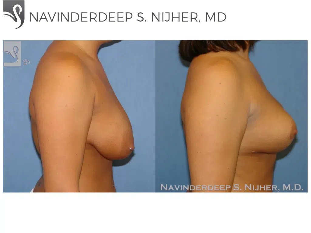 Before and After Image: Breast Lift (Mastopexy) Case #42185 - right-side