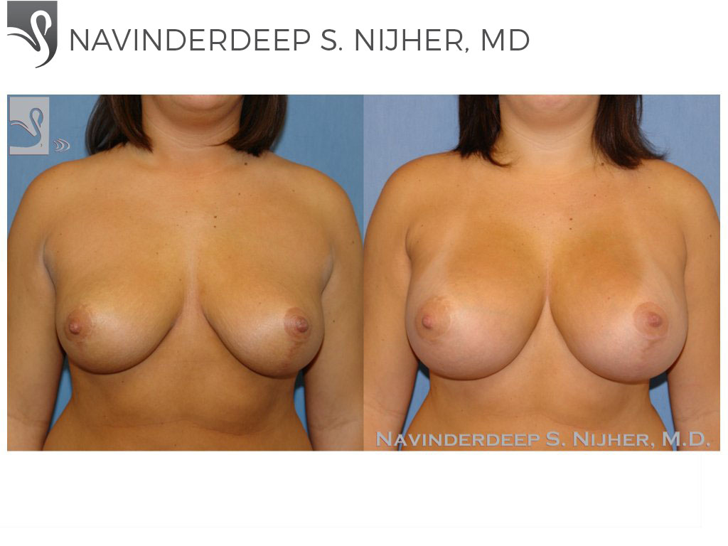 Before and After Image: Breast Revisions Case #42185 - front