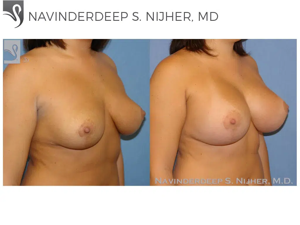 Before and After Image: Breast Revisions Case #42185 - right-front-oblique
