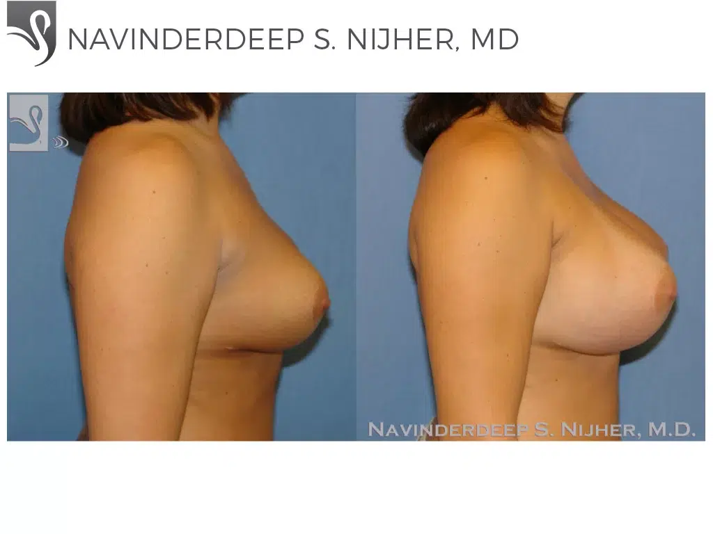 Before and After Image: Breast Revisions Case #42185 - right-side