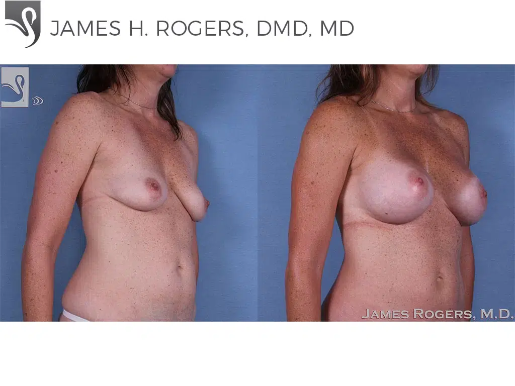 Before and After Image: Breast Augmentation Case #42239 - right-front-oblique