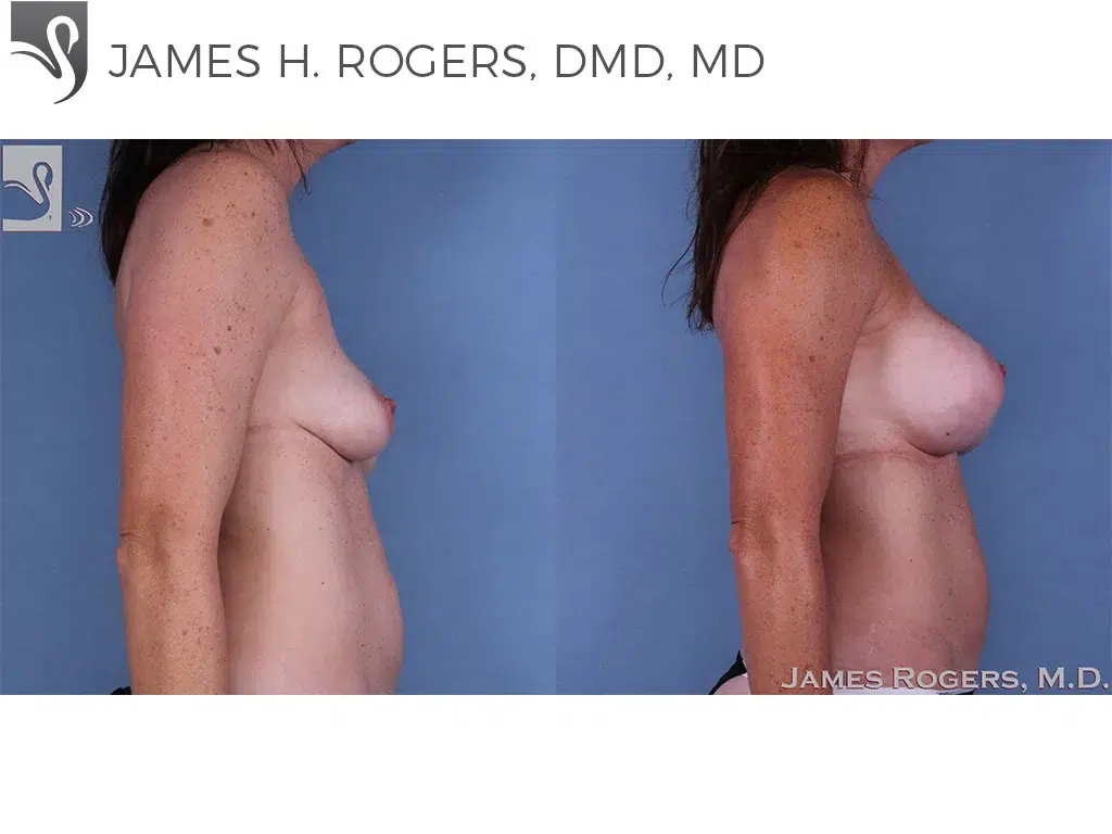 Before and After Image: Breast Augmentation Case #42239 - right-side
