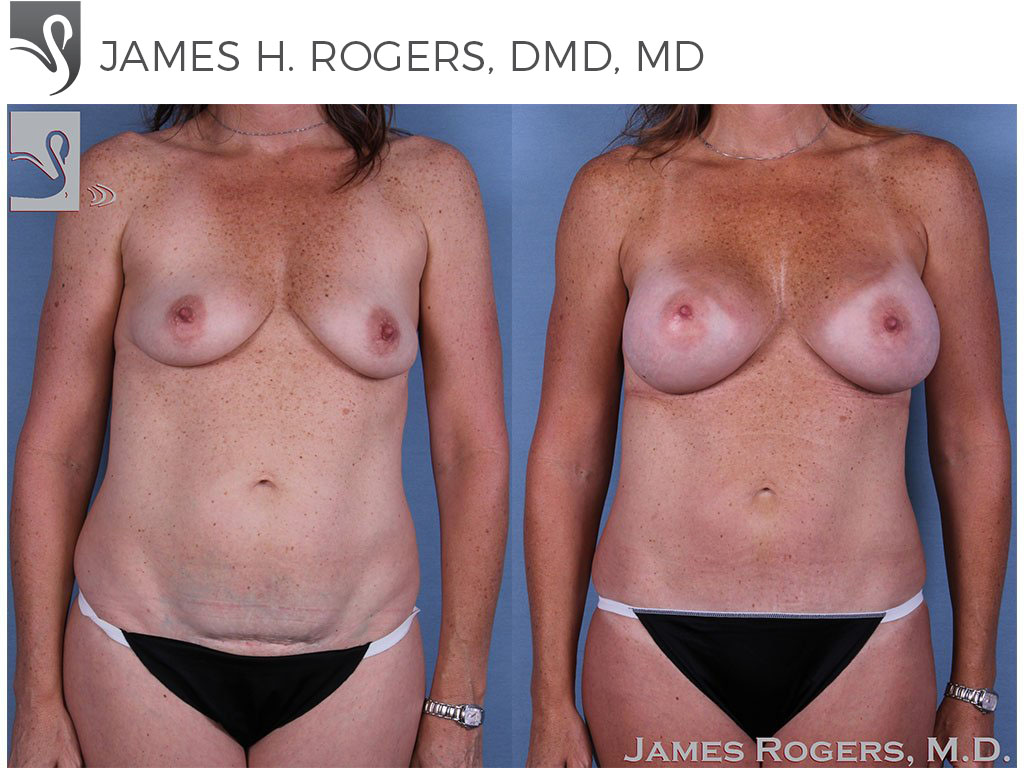 Before and After Image: Mommy Makeover Case #42239 - front