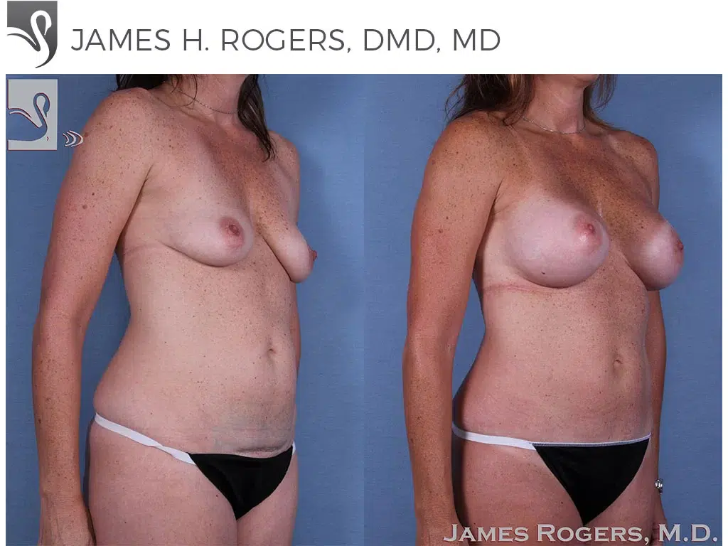 Before and After Image: Mommy Makeover Case #42239 - right-front-oblique