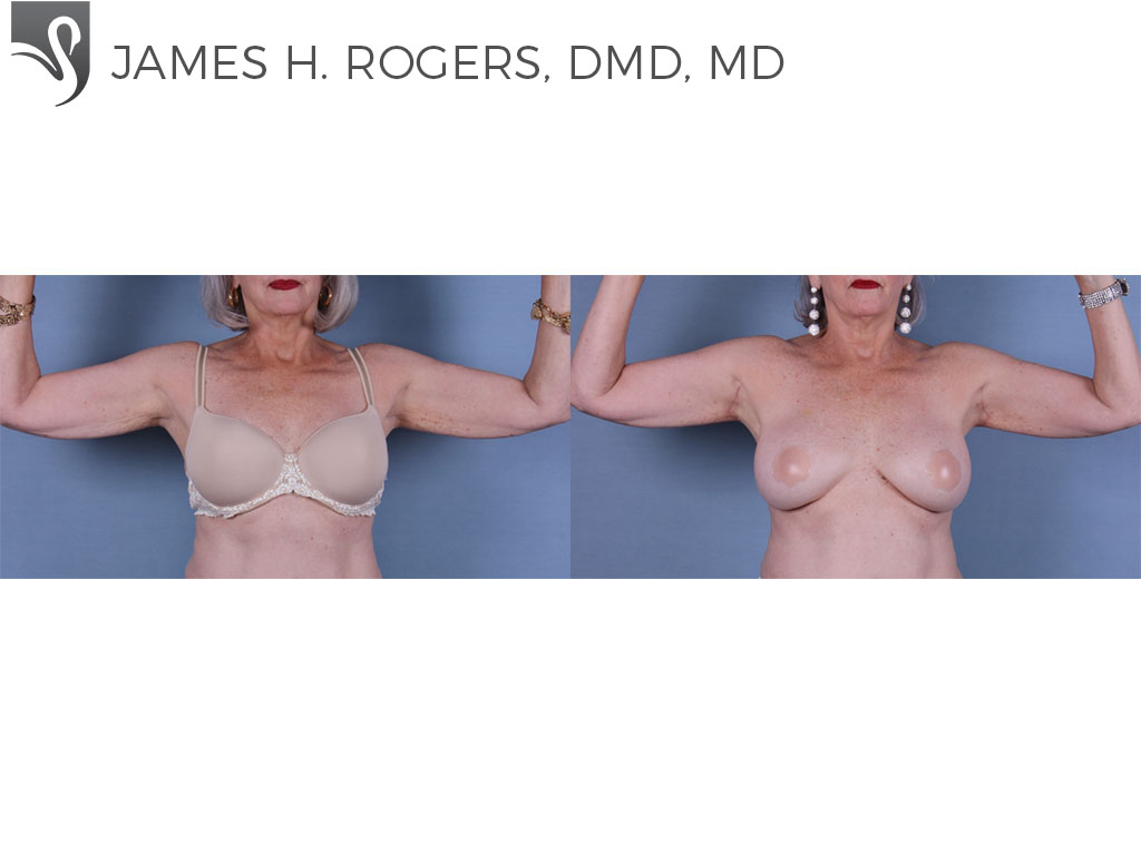 Before and After Image: Arm Lift Case #42251