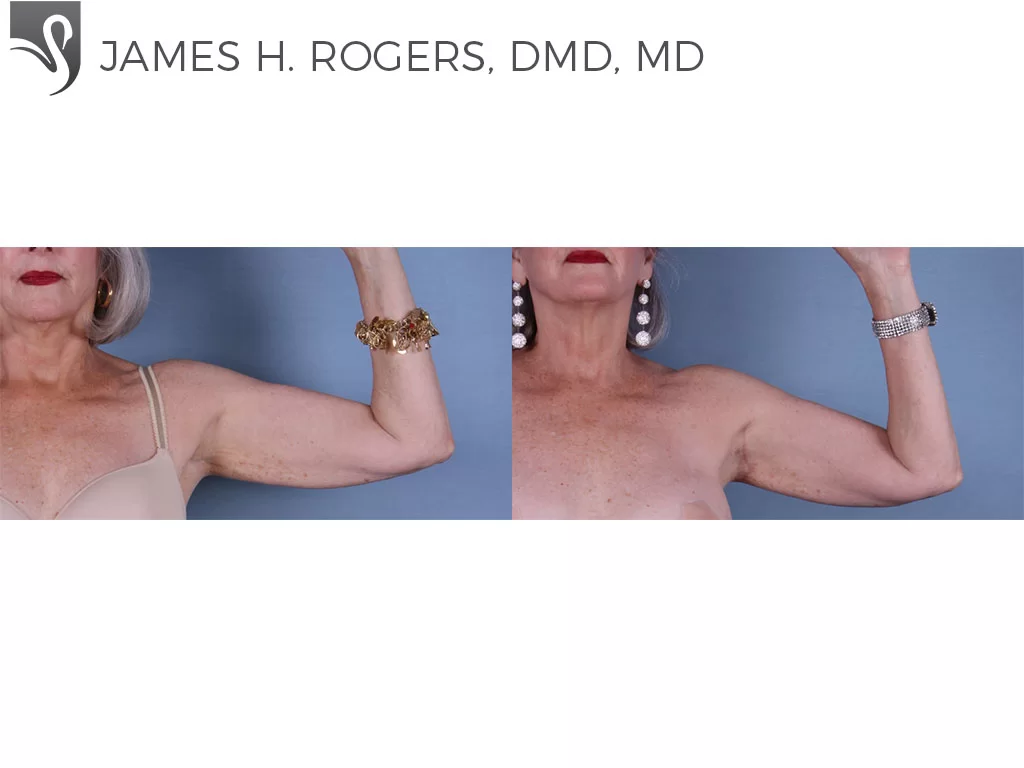 Before and After Image: Arm Lift Case #42251 - front