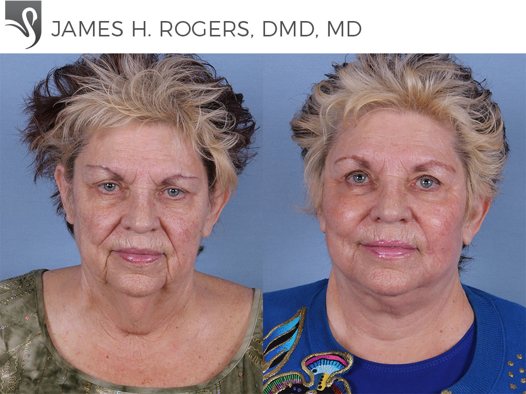 Before and After Image: Face Lift Case #42583 - front