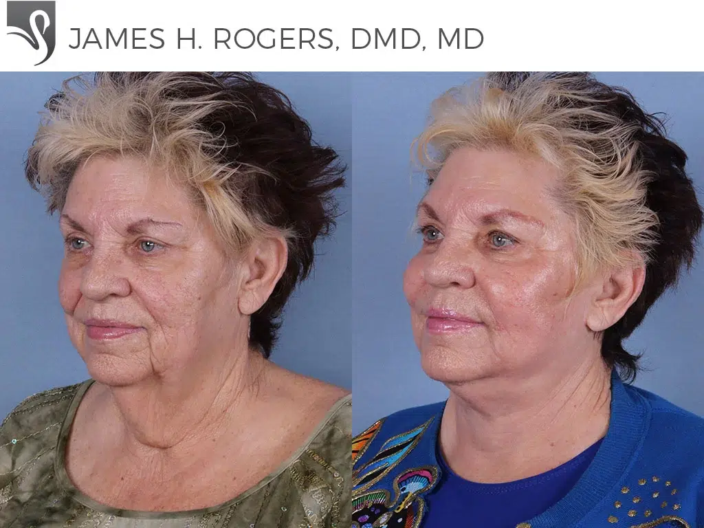 Before and After Image: Face Lift Case #42583 - left-front-oblique
