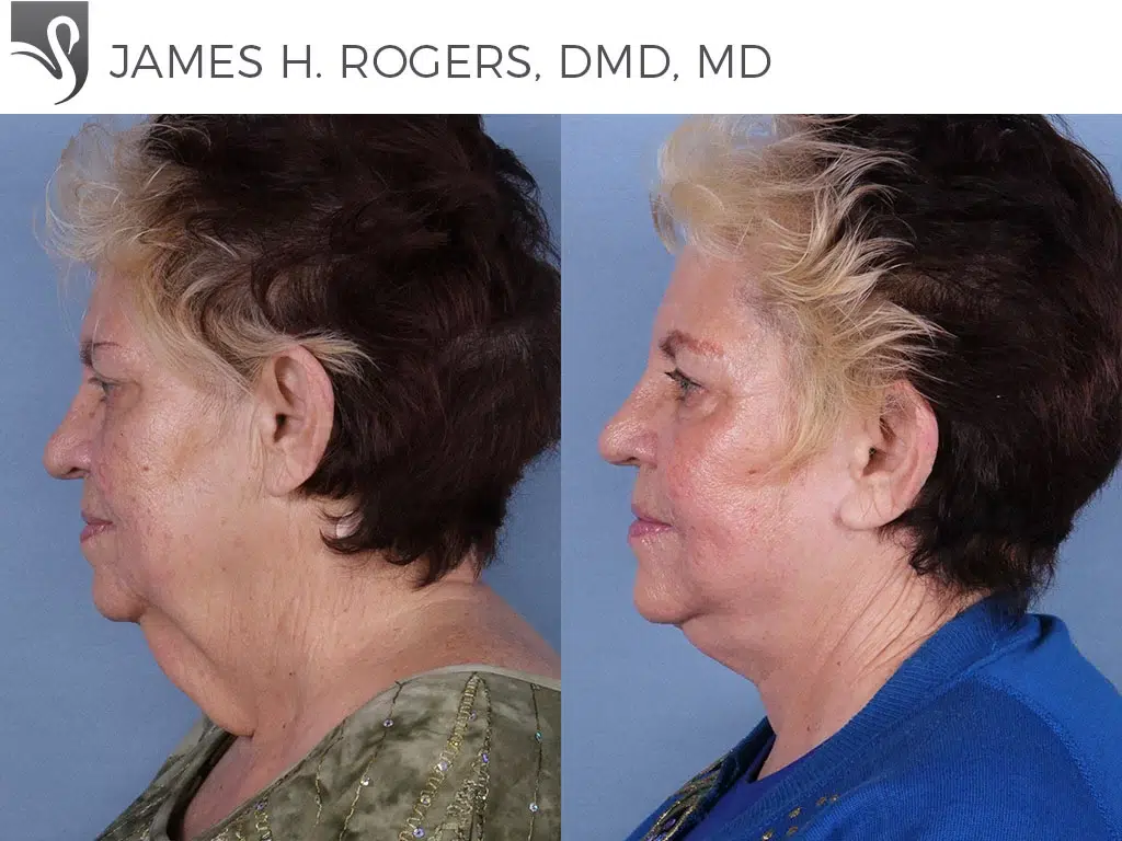 Before and After Image: Face Lift Case #42583 - left-side