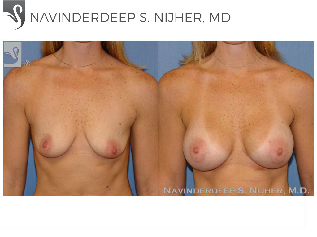 Before and After Image: Breast Augmentation Case #42792 - front