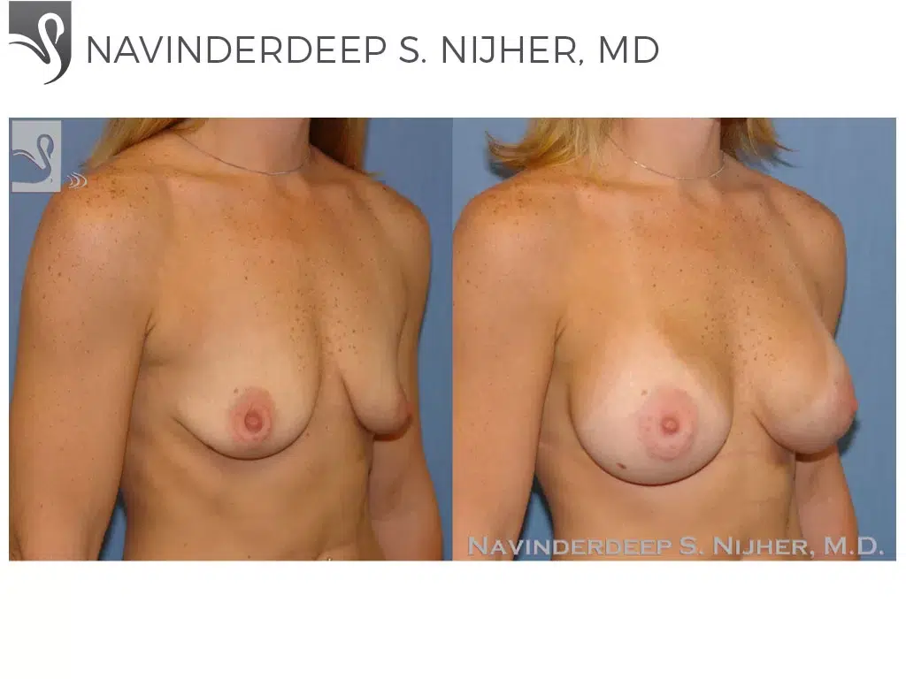 Before and After Image: Breast Augmentation Case #42792 - right-front-oblique