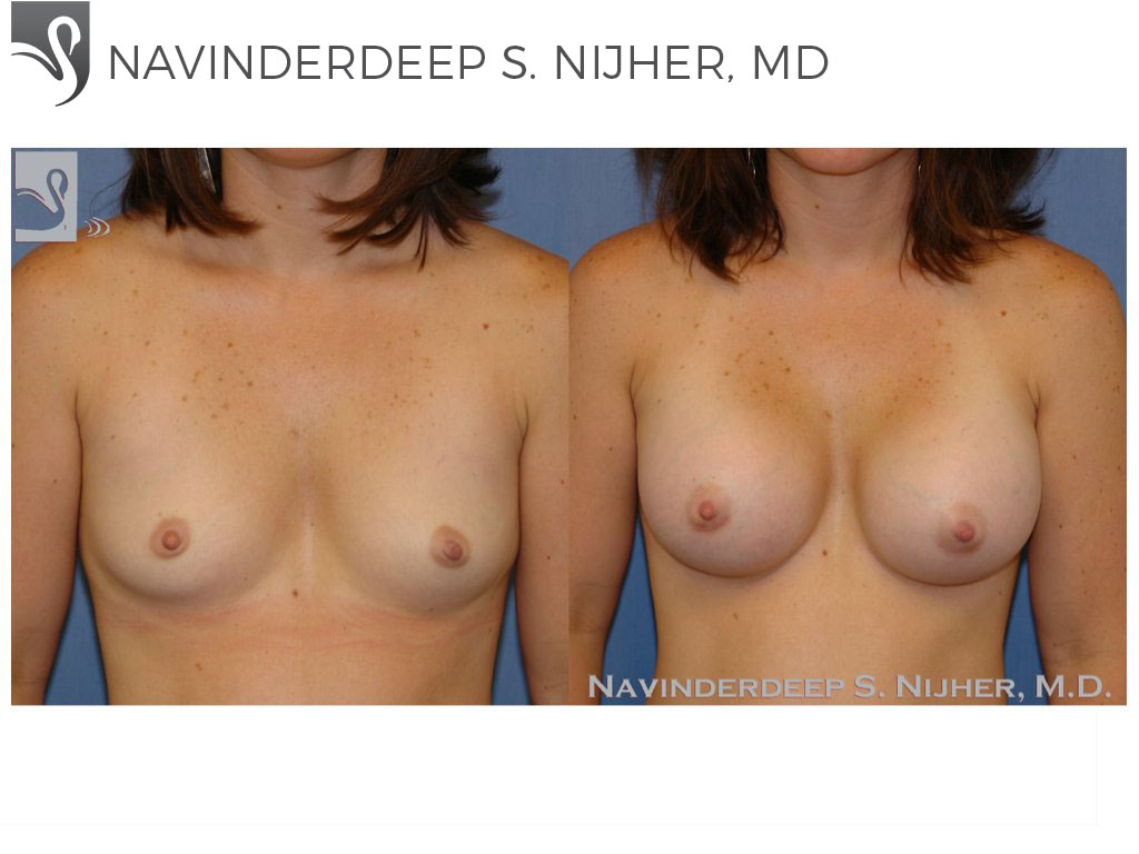 Before and After Image: Breast Augmentation Case #42871 - front