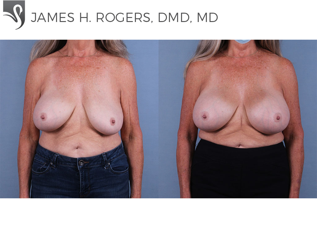 Before and After Image: Breast Revisions Case #43316