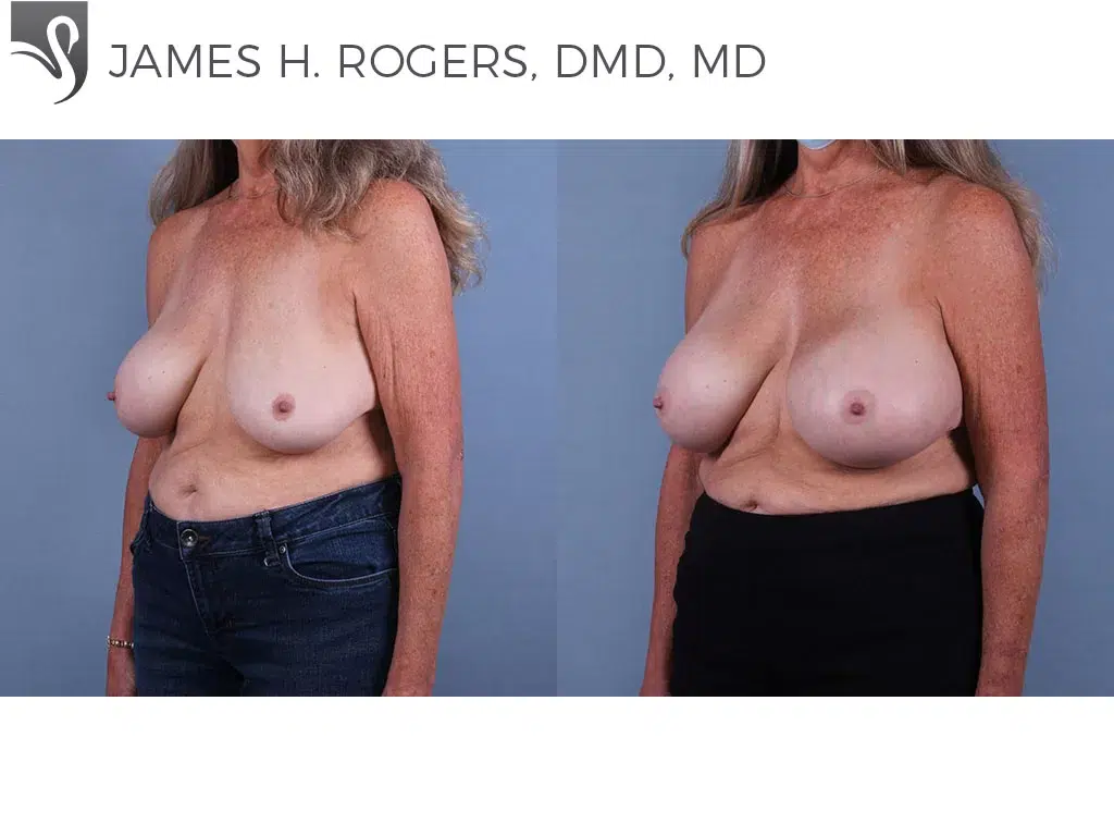 Before and After Image: Breast Revisions Case #43316 - left-front-oblique