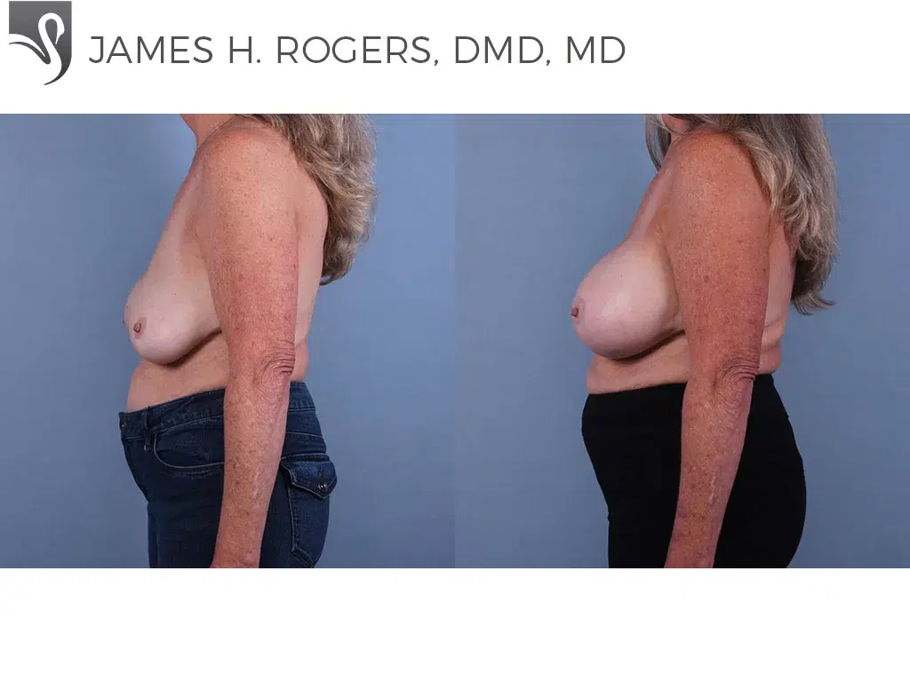 Before and After Image: Breast Revisions Case #43316 - left-side