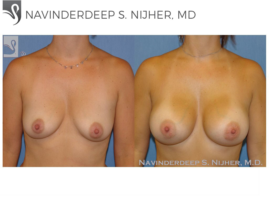 Before and After Image: Breast Augmentation Case #43336 - front
