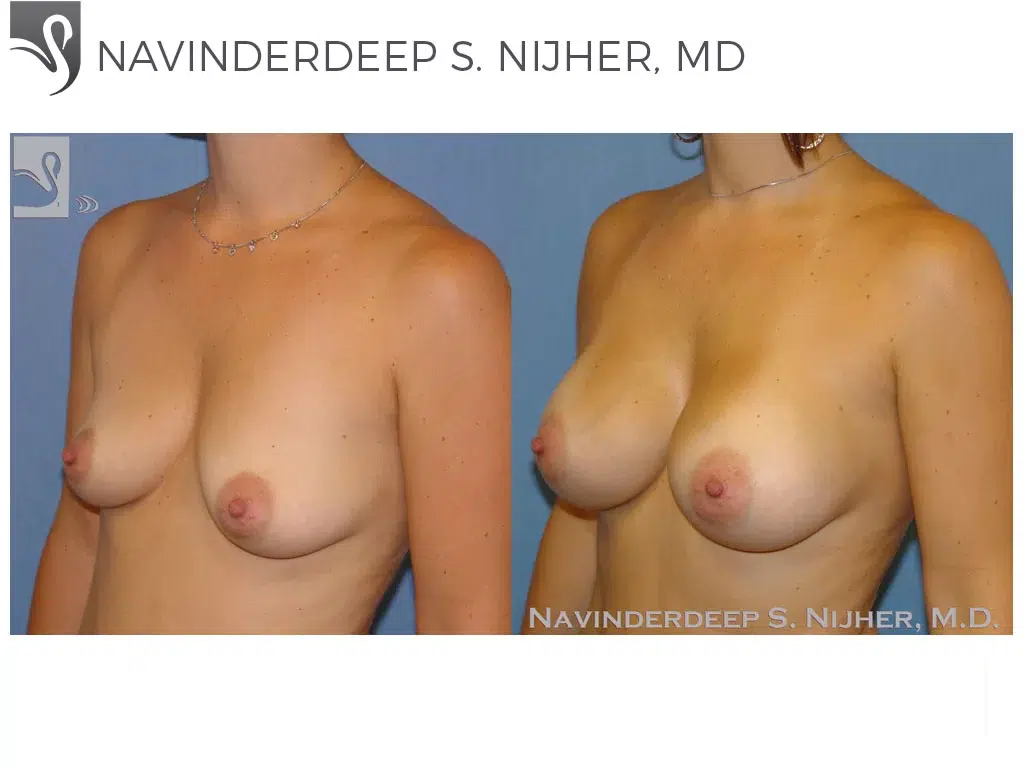 Before and After Image: Breast Augmentation Case #43336 - left-front-oblique