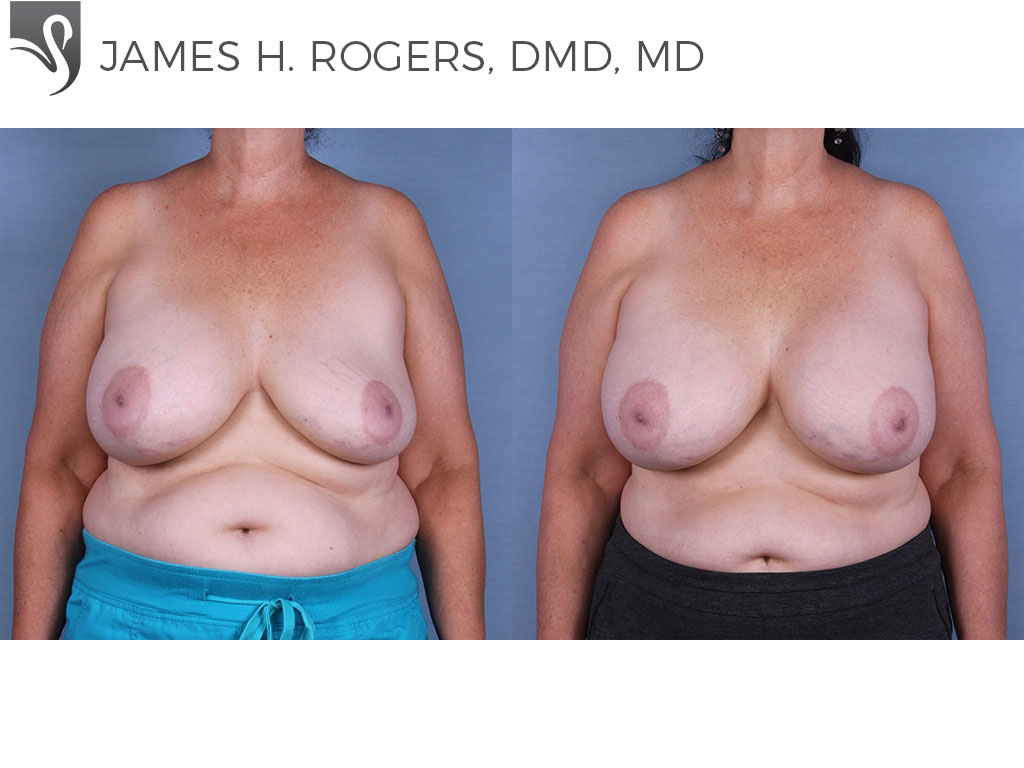 Before and After Image: Breast Revisions Case #43399 - front