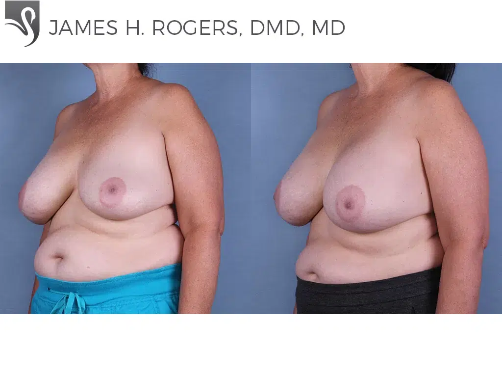 Before and After Image: Breast Revisions Case #43399 - left-front-oblique