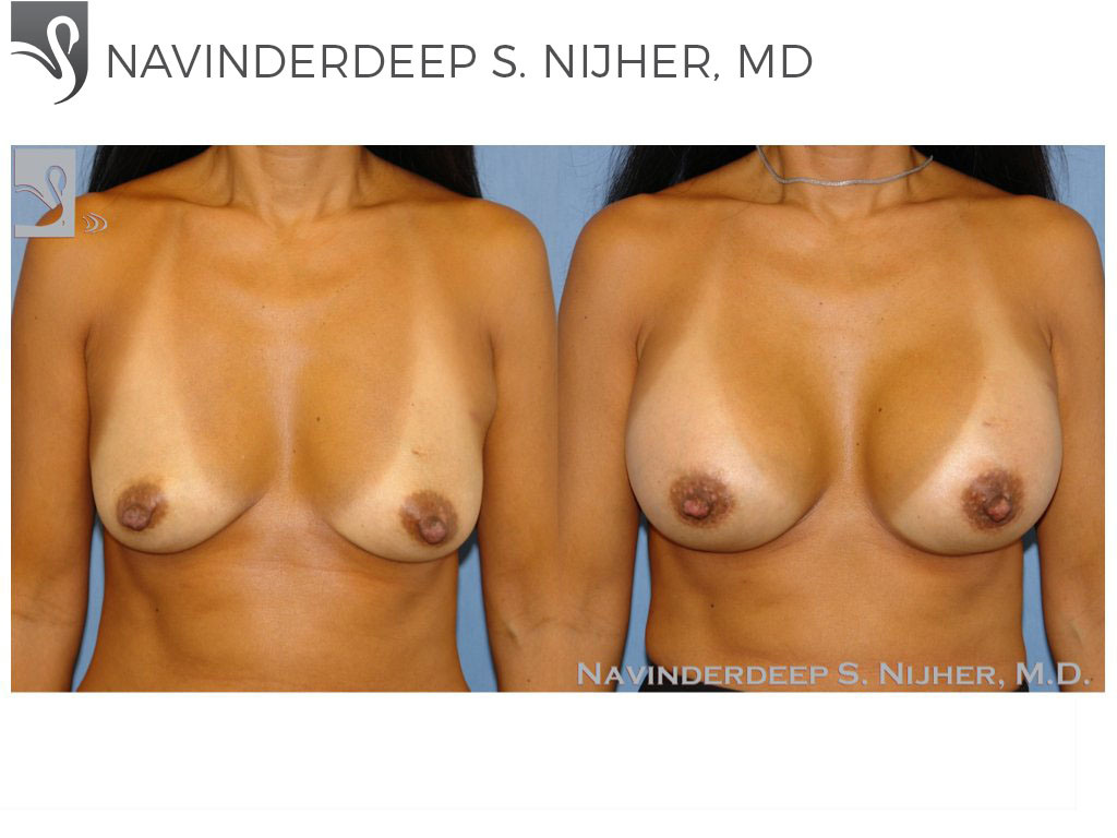 Before and After Image: Breast Augmentation Case #43824 - front
