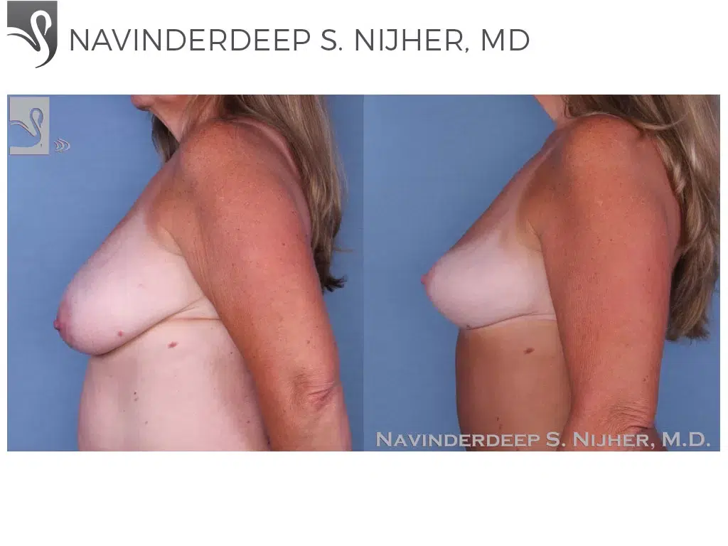 Before and After Image: Breast Lift (Mastopexy) Case #44041 - left-side