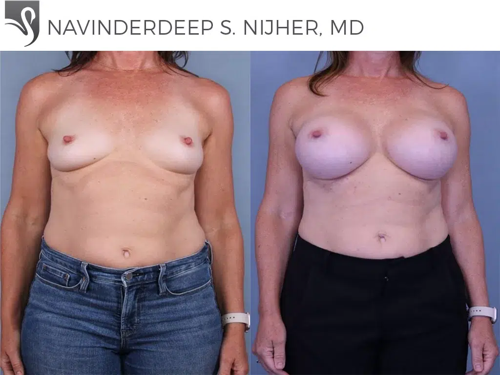Before and After Image: Breast Augmentation Case #44221 - front