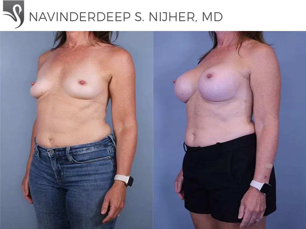 Before and After Image: Breast Augmentation Case #44221 - left-front-oblique