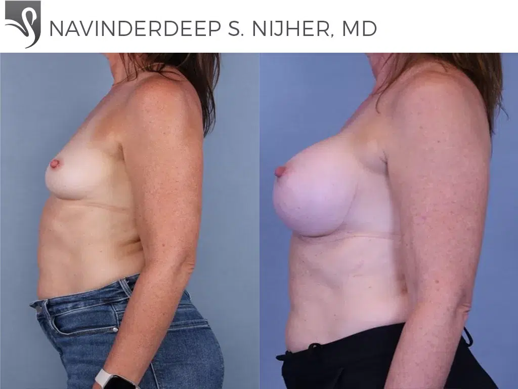 Before and After Image: Breast Augmentation Case #44221 - left-side