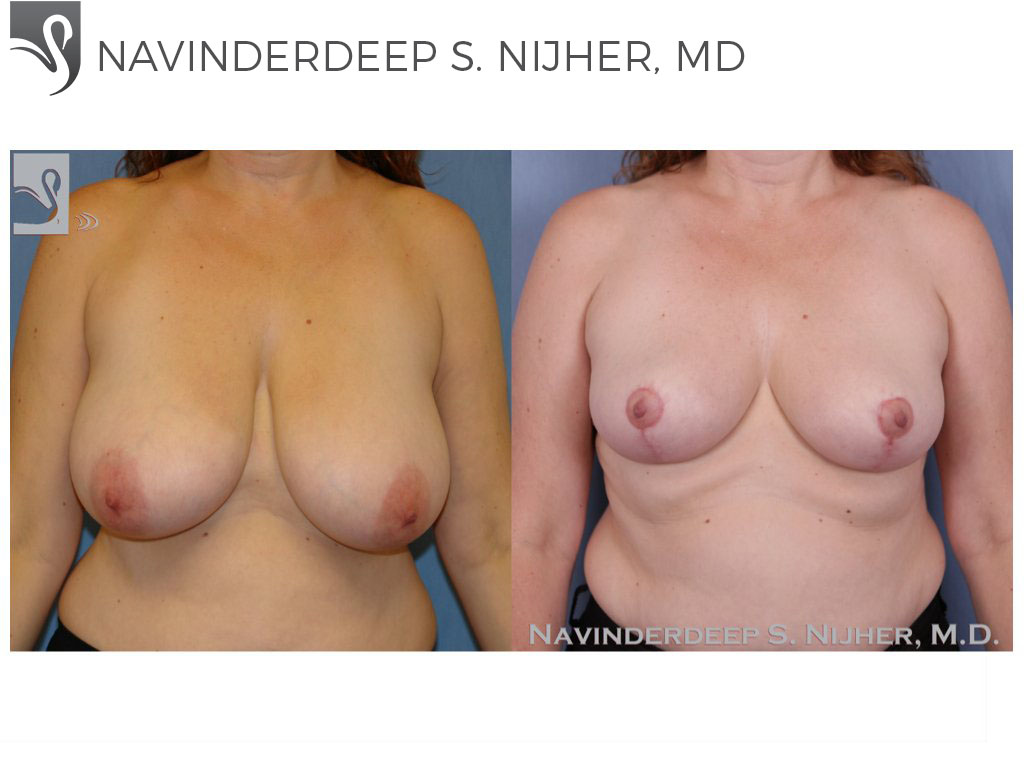 Before and After Image: Female Breast Reduction Case #44224 - front