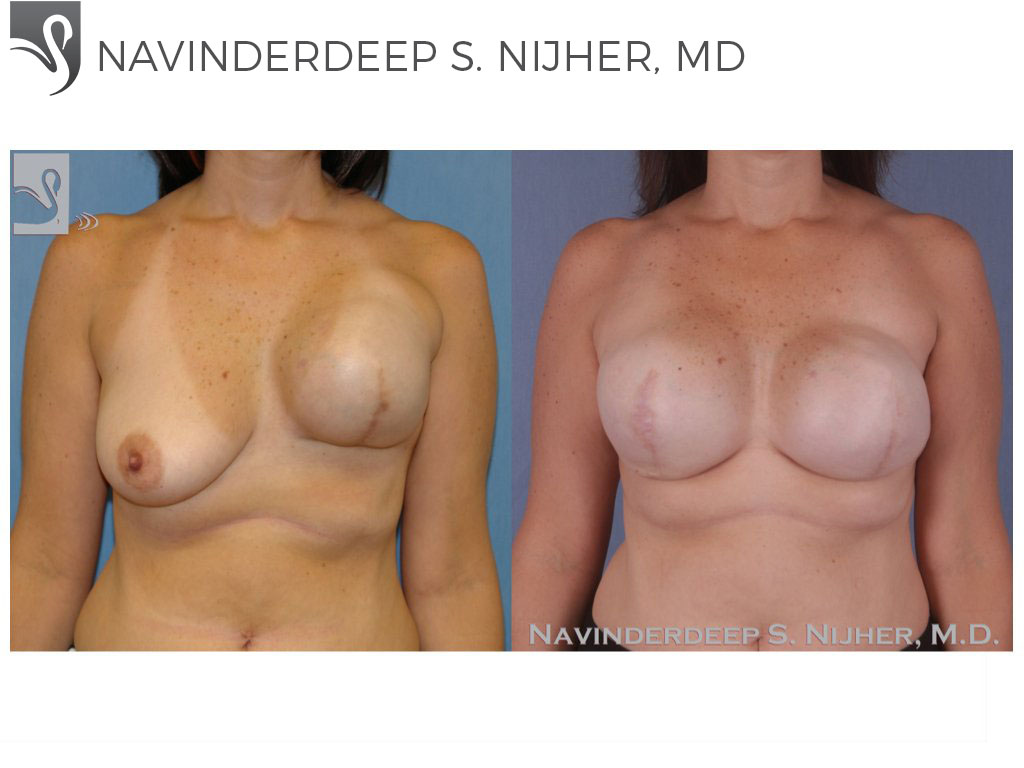 Before and After Image: Breast Reconstruction Case #44713