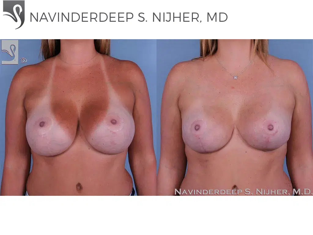 Before and After Image: Breast Revisions Case #44752 - front