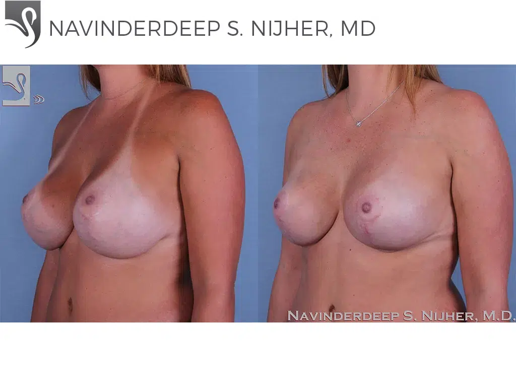 Before and After Image: Breast Revisions Case #44752 - left-front-oblique