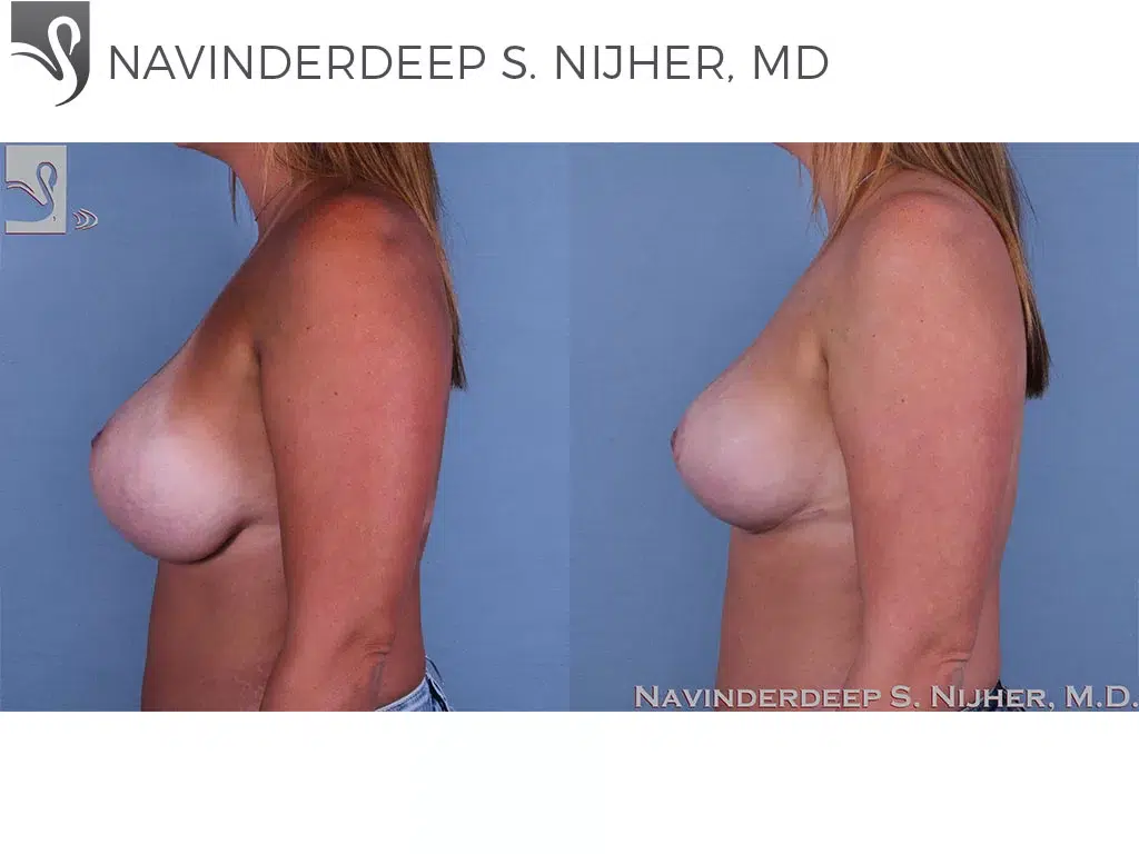 Before and After Image: Breast Revisions Case #44752 - left-side