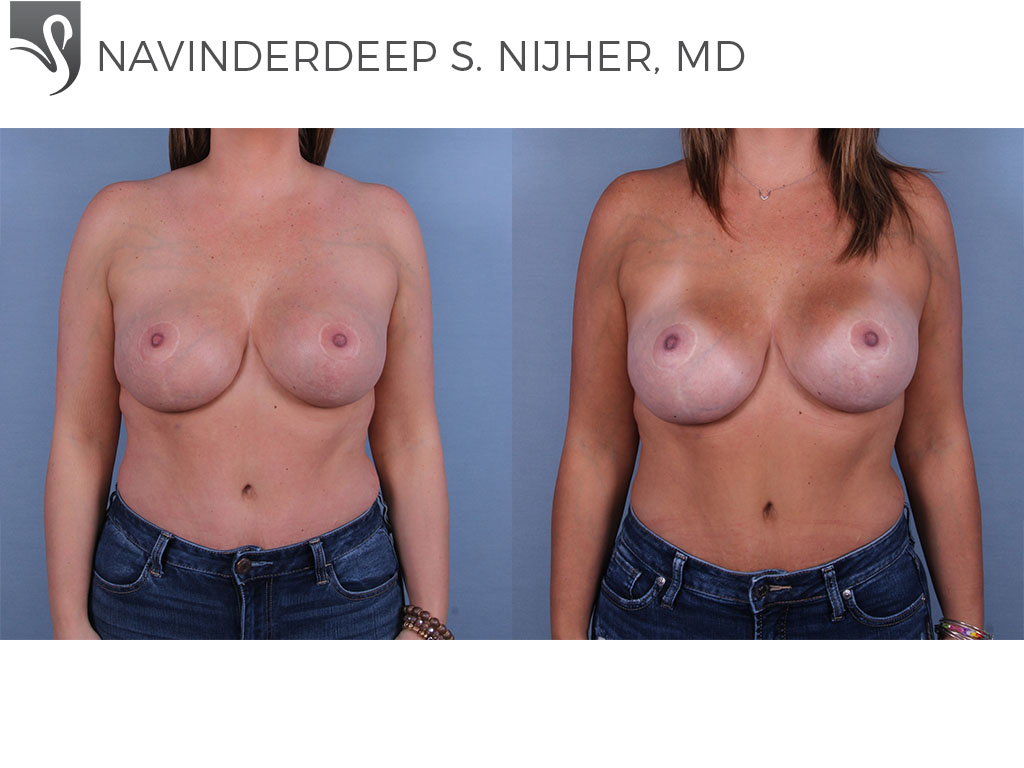 Before and After Image: Breast Revisions Case #44752