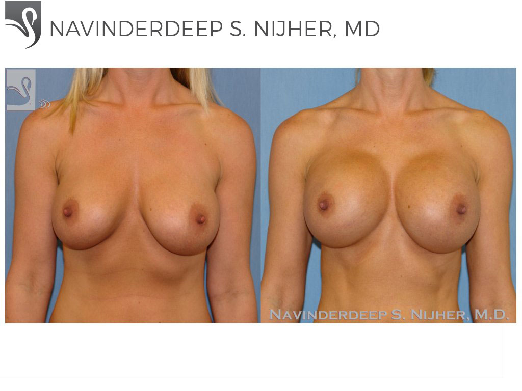 Before and After Image: Breast Augmentation Case #45044 - front