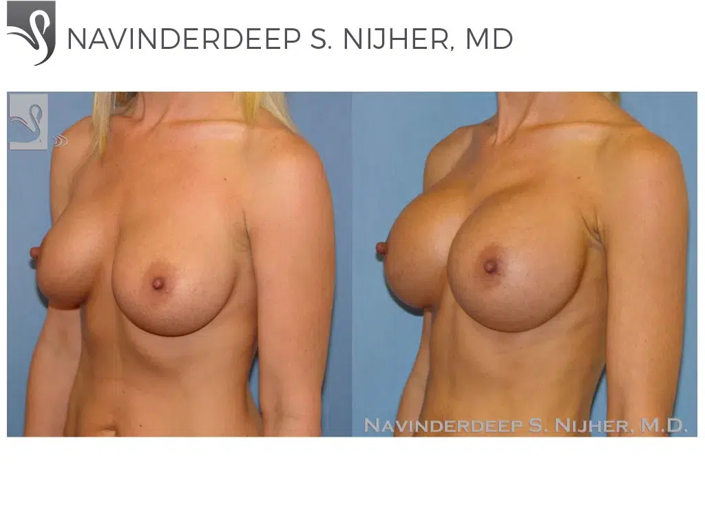 Before and After Image: Breast Augmentation Case #45044 - left-front-oblique