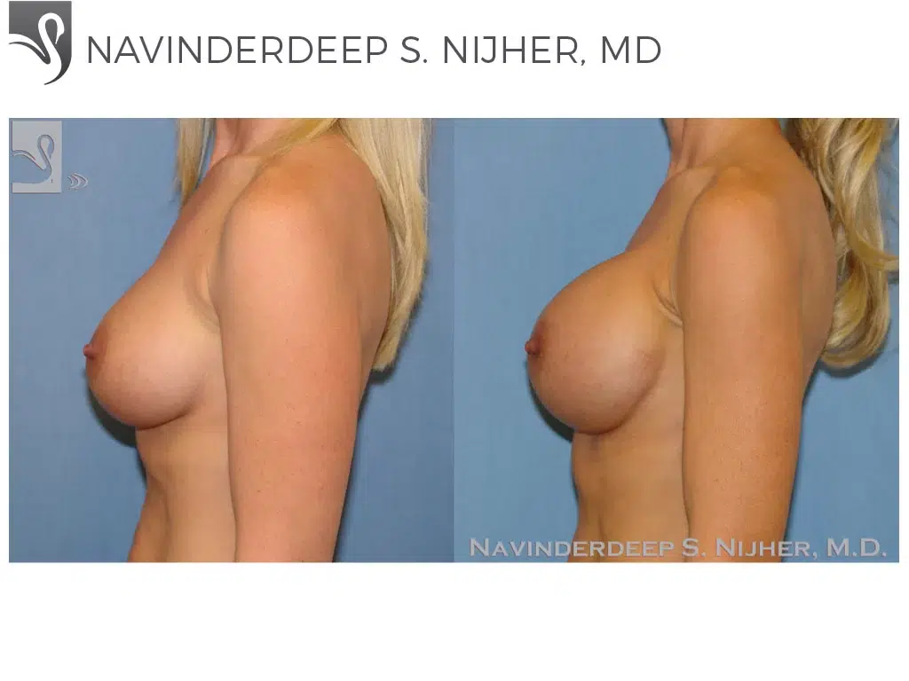 Before and After Image: Breast Augmentation Case #45044 - left-side