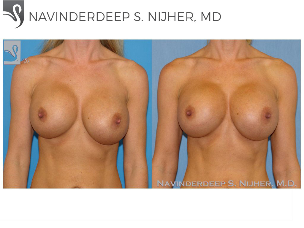 Before and After Image: Breast Revisions Case #45044 - front