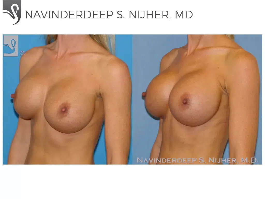 Before and After Image: Breast Revisions Case #45044 - left-front-oblique