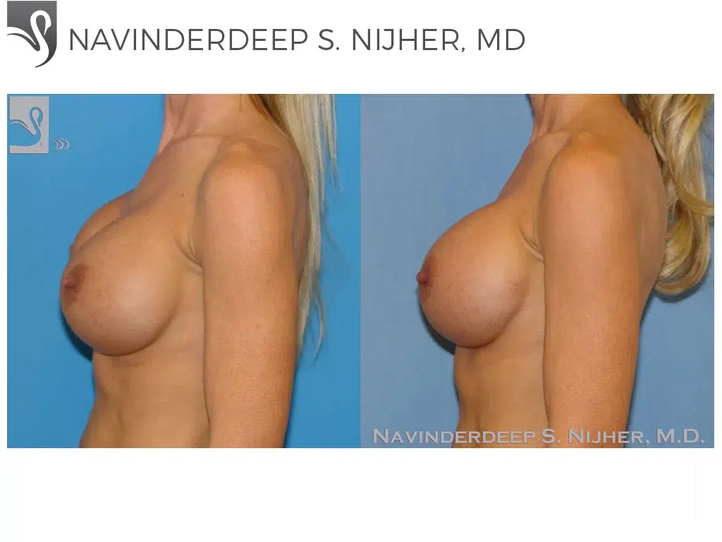 Before and After Image: Breast Revisions Case #45044 - left-side