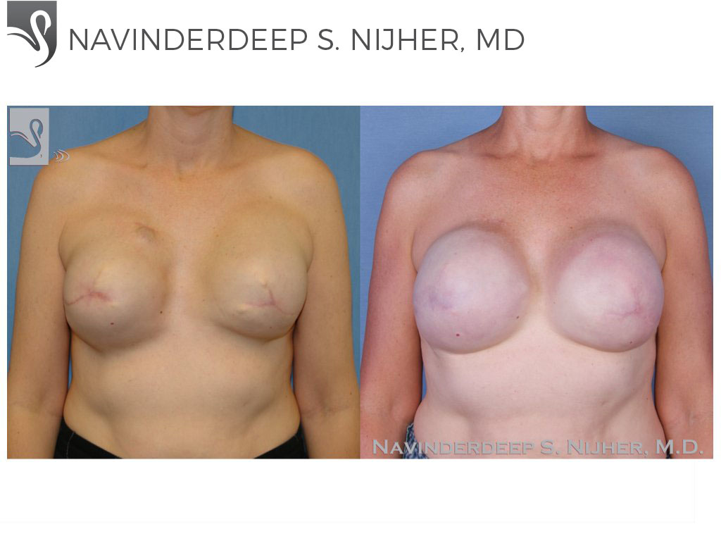 Before and After Image: Breast Reconstruction Case #45095 - front